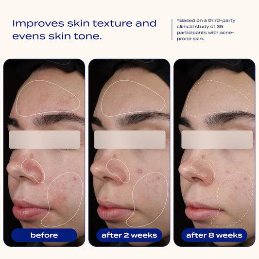 banu AHA + BHA Blemish Clearing and Exfoliating Serum with 2% Salicylic Acid