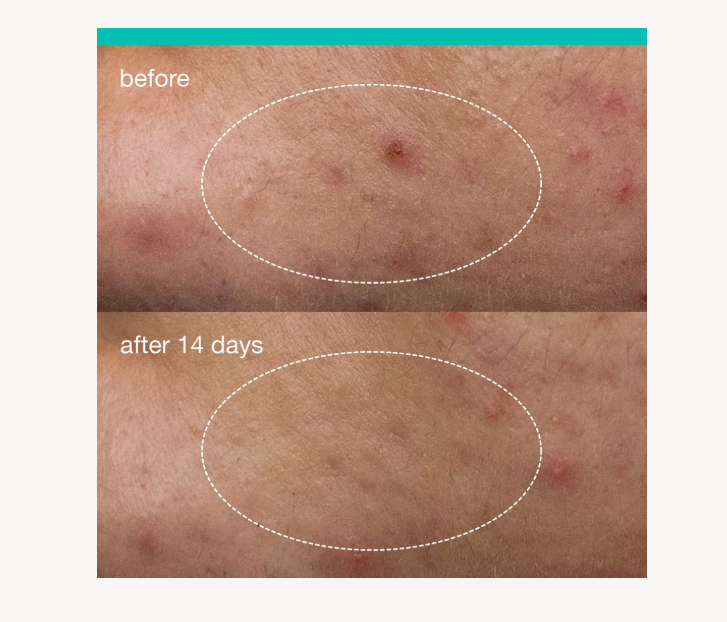 Deep Acne Invisible Liquid Patch