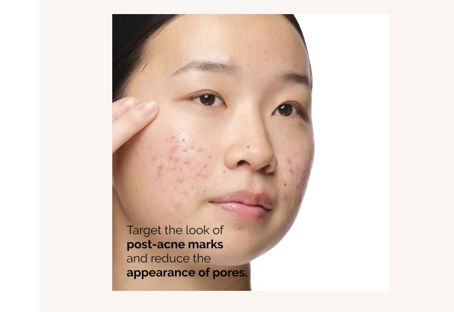 Aloe 2% + NAG 2% Solution for Post-Acne Marks
