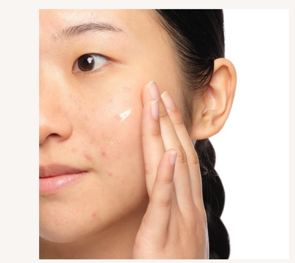 Aloe 2% + NAG 2% Solution for Post-Acne Marks