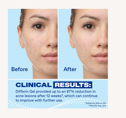 Adapalene 0.1% Acne Treatment Gel