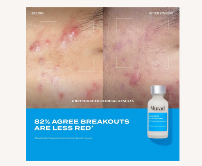 Deep Relief Acne Treatment