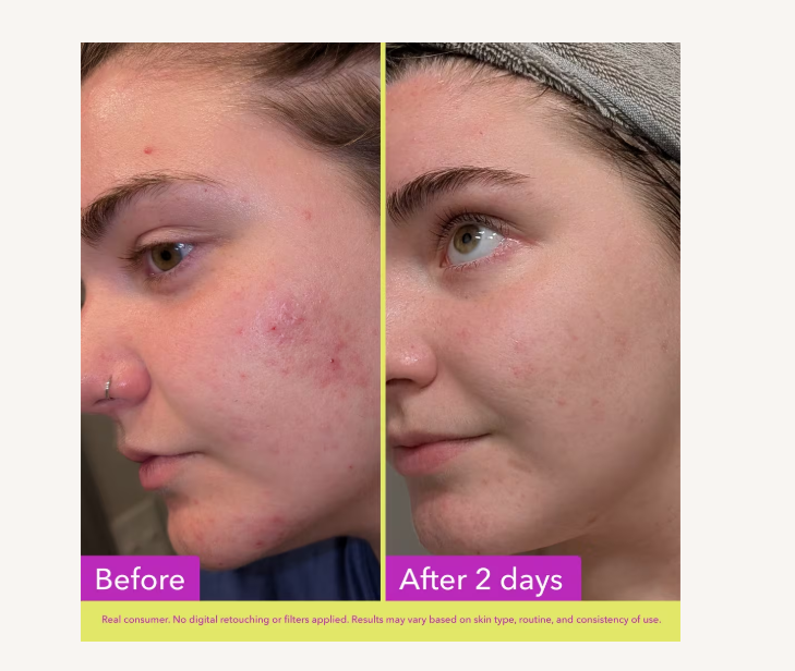 10% Azelaic Acid Treatment