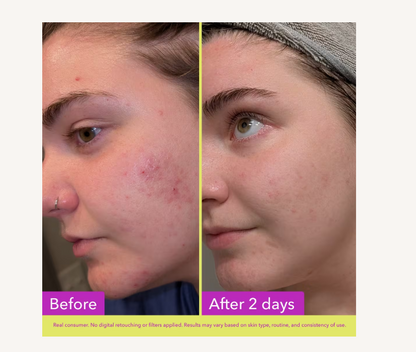 10% Azelaic Acid Treatment