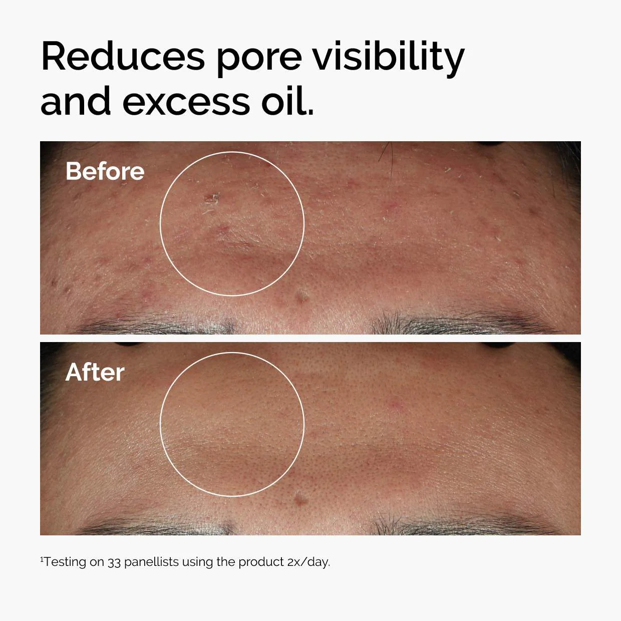 The Ordinary  Niacinamide 10% + Zinc 1%  Serum for Oily Skin