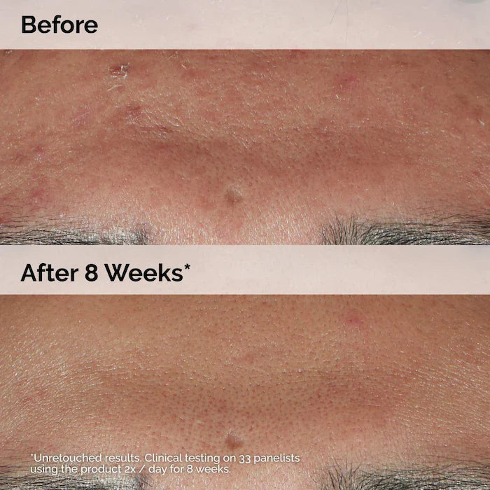The Ordinary  Niacinamide 10% + Zinc 1% Oil Control Serum