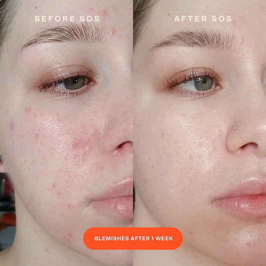 Tower 28 Beauty  SOS Intensive Redness Relief Serum with Hypochlorous Acid