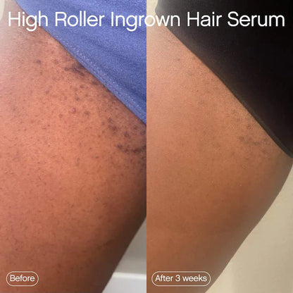 Topicals  High Roller Ingrown Hair Tonic with AHA and BHA