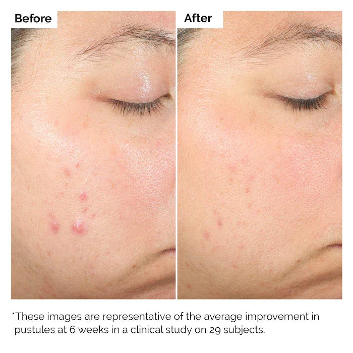 The Ordinary  Salicylic Acid 2% Exfoliating Blemish Solution