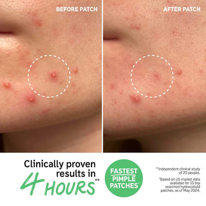 The INKEY List  Hydrocolloid Invisible Pimple Patches + Salicylic Acid