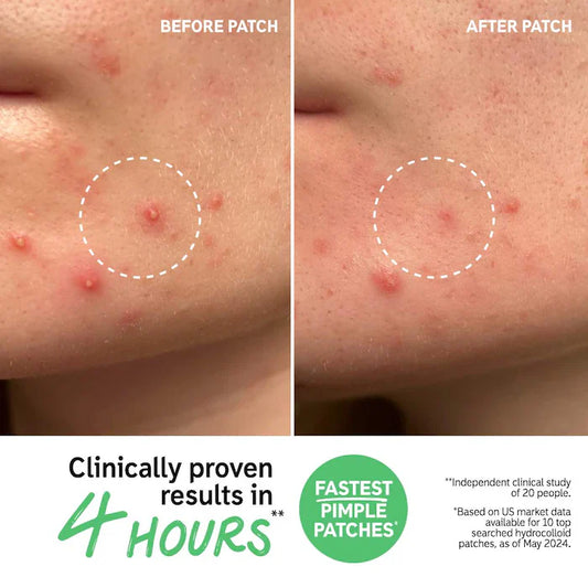 The INKEY List  Hydrocolloid Invisible Pimple Patches + Salicylic Acid