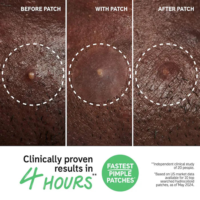 The INKEY List  Hydrocolloid Invisible Pimple Patches + Salicylic Acid