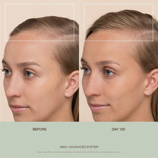 Vegamour  GRO+ Advanced Balancing Shampoo and Conditioner Set for Severe Signs of Thinning