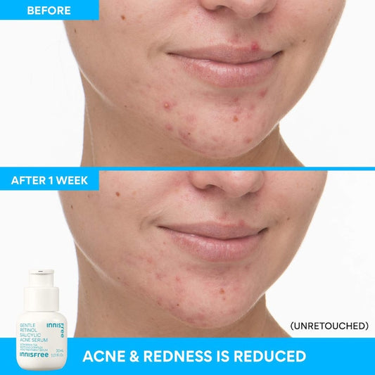 innisfree  Gentle Retinol Salicylic Acne Serum