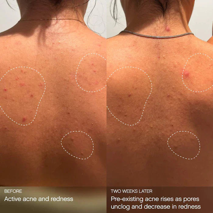 Topicals  Clearly Clarifying & Calming Mist For Acne-Prone Skin