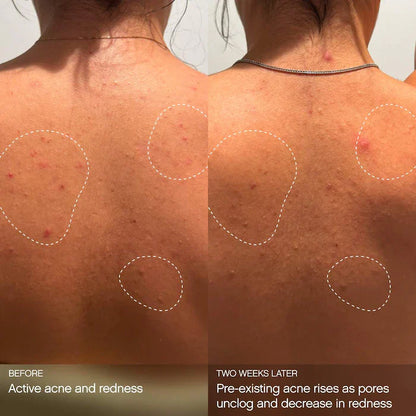 Topicals  Clearly Clarifying & Calming Mist For Acne-Prone Skin