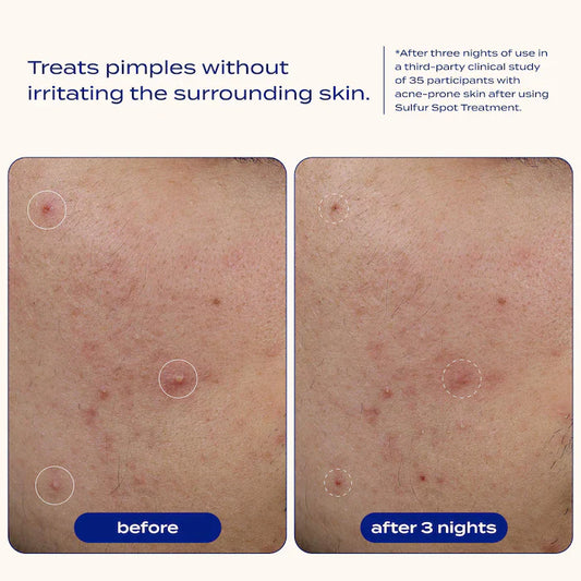 banu  Sulfur Spot Treatment for Acne and Blemishes