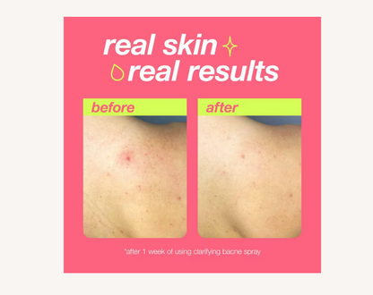 Clear Start Clarifying Bacne Spray