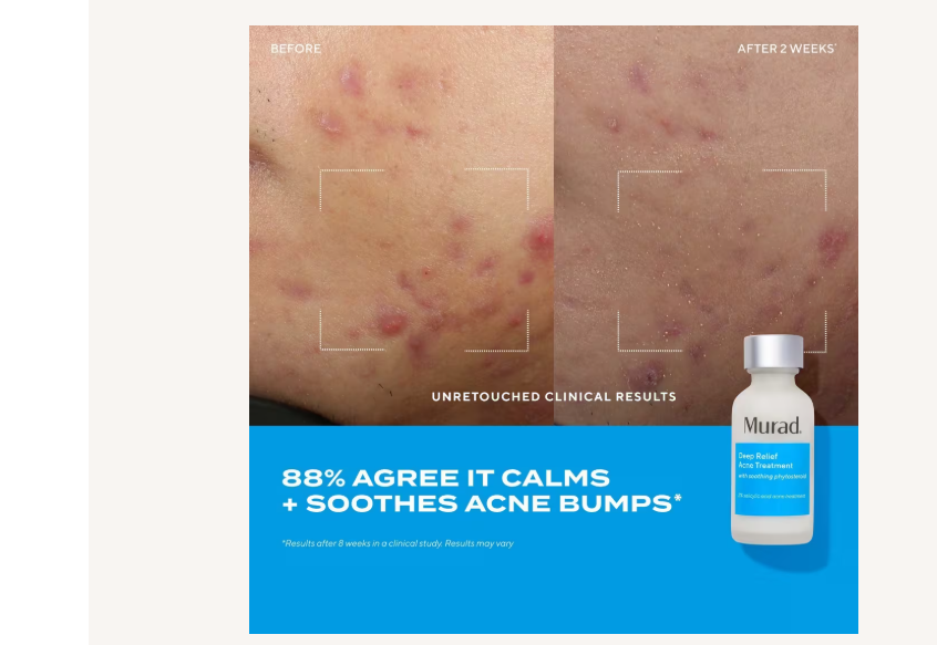 Deep Relief Acne Treatment