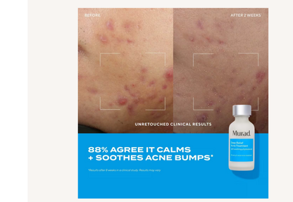 Deep Relief Acne Treatment