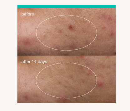 Deep Acne Invisible Liquid Patch